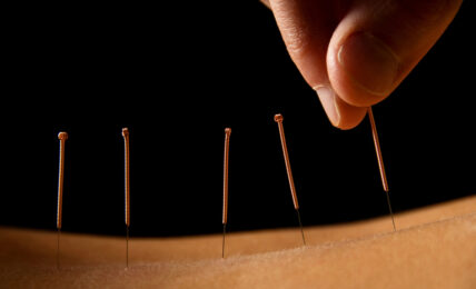 Acupuncture Intervention - People Development Magazine