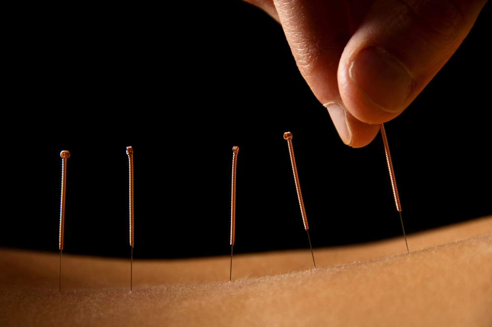 Acupuncture Intervention - People Development Magazine